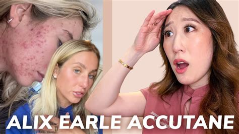 alix earle before accutane|Dermatologist responds to Alix Earles theory on why。